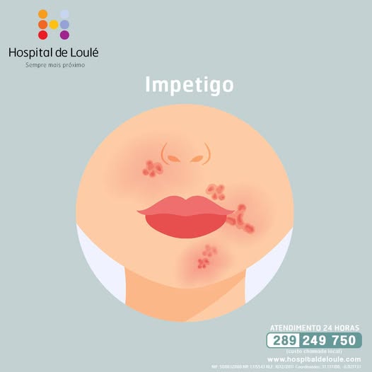 Do you know what impetigo is?