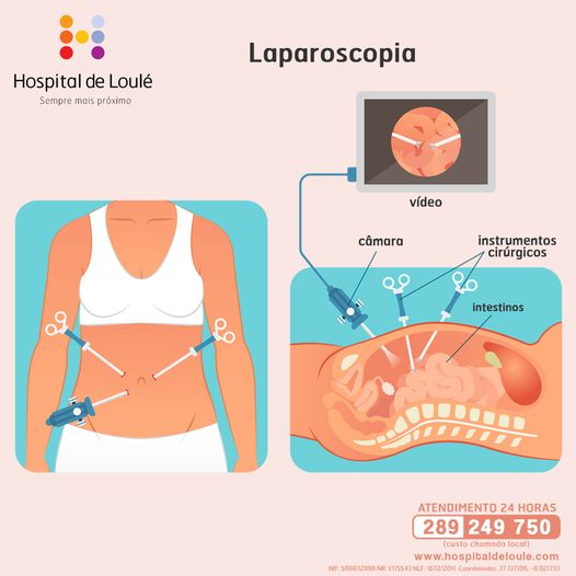 O que é uma laparoscopia?