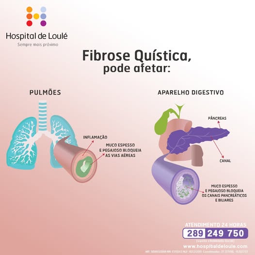 Sabe o que é a Fibrose Quística?