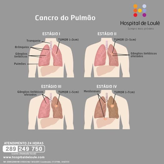 Lung Cancer: pay attention to the signs