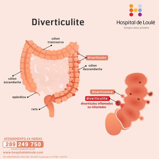 Como controlar a diverticulite pela alimentação?