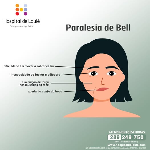 Sabe o que é a Paralisia de Bell?