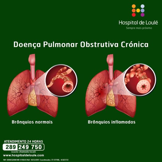 Doença Pulmonar Obstrutiva Crónica