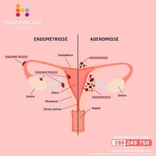 Sabe a diferença ente endometriose e adenomiose?