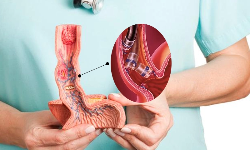 Laqueação de Varizes Esofágicas